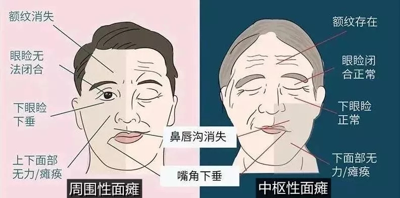 面瘫这样做