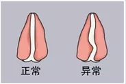 了解鼻中隔偏曲